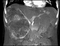 Hepatoma - CTisus CT Scan