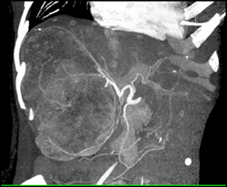 Hepatoma - CTisus CT Scan