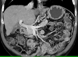 Cirrhosis - CTisus CT Scan