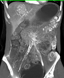 Focal Nodular Hyperplasia (FNH) - CTisus CT Scan