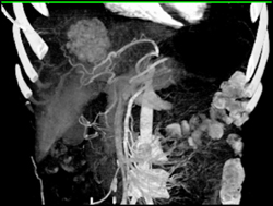 Focal Nodular Hyperplasia (FNH) - CTisus CT Scan