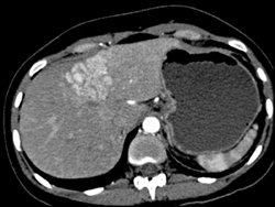 Focal Nodular Hyperplasia (FNH) - CTisus CT Scan