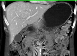 Focal Nodular Hyperplasia (FNH) - CTisus CT Scan