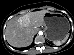 Focal Nodular Hyperplasia (FNH) - CTisus CT Scan