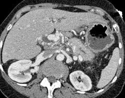 Cavernous Transformation of the Portal Vein - CTisus CT Scan