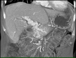 Cavernous Transformation of the Portal Vein - CTisus CT Scan