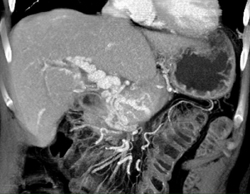 Cavernous Transformation of the Portal Vein - CTisus CT Scan