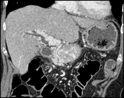 Cavernous Transformation of the Portal Vein - CTisus CT Scan