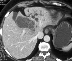 Cholangiocarcinoma - CTisus CT Scan