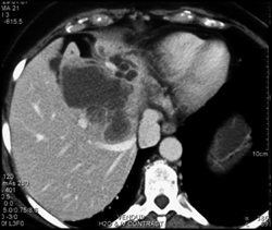 Cholangiocarcinoma - CTisus CT Scan