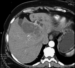 Cholangiocarcinoma - CTisus CT Scan