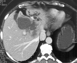 Cholangiocarcinoma - CTisus CT Scan