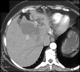 Cholangiocarcinoma - CTisus CT Scan