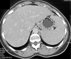 Hepatitis C With Nodes in Porta - CTisus CT Scan