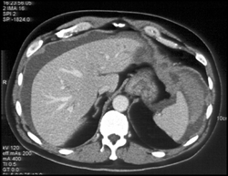 Hepatic Laceration With Hemoperitoneum - CTisus CT Scan