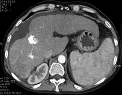 Av Shunt in Cirrhotic Liver - CTisus CT Scan