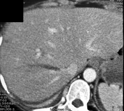 Liver Laceration With Clot - CTisus CT Scan