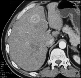 Liver Metastases - CTisus CT Scan