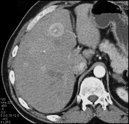 Liver Metastases - CTisus CT Scan