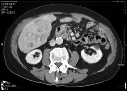 Liver Metastases-vascular - CTisus CT Scan