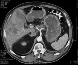 Hepatoma - CTisus CT Scan