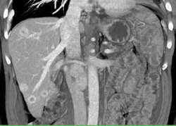 Liver Metastases From Thyroid Cancer - CTisus CT Scan