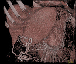 Cirrhosis With Varices - CTisus CT Scan