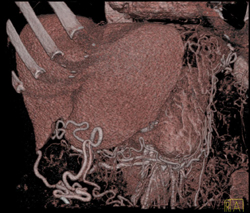 Cirrhosis With Varices - CTisus CT Scan