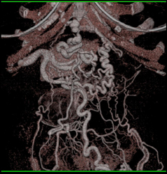 Cirrhosis With Varices - CTisus CT Scan