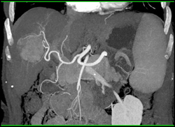 Hepatoma - CTisus CT Scan