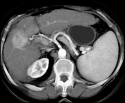 Hepatoma - CTisus CT Scan