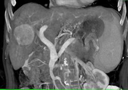 Cirrhosis Varices and Hepatocellular Carcinoma (HCC) - CTisus CT Scan