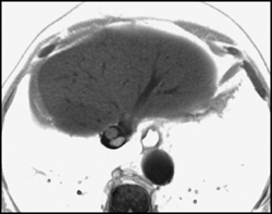 Clot in Inferior Vena Cava (IVC) - CTisus CT Scan