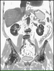 Clot in Inferior Vena Cava (IVC) From Hepatocellular Carcinoma (HCC) - CTisus CT Scan