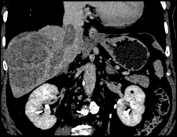 Hepatocellular Carcinoma (HCC) With IVC Clot - CTisus CT Scan