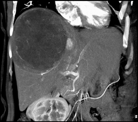 Fibrous Sarcoma in the Liver - CTisus CT Scan