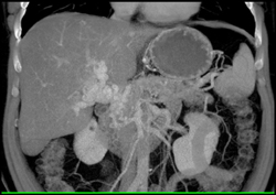 Cavernous Transformation of the Portal Vein - CTisus CT Scan