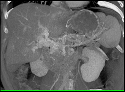 Cavernous Transformation of the Portal Vein - CTisus CT Scan