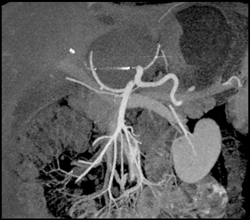 Cirrhosis - CTisus CT Scan