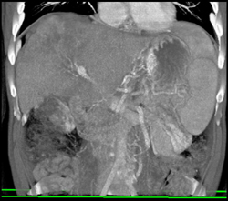 Cholangiocarcinoma - CTisus CT Scan