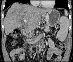 Cholangiocarcinoma - CTisus CT Scan