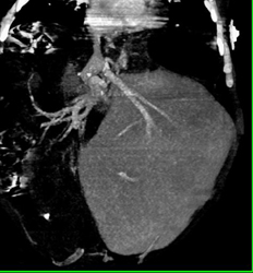 Post Liver Transplant - CTisus CT Scan