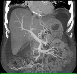 Cirrhosis With Narrowed Portal Vein - CTisus CT Scan