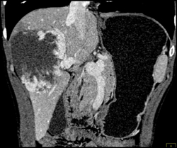 Giant Hemangioma - CTisus CT Scan