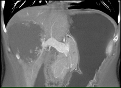 Giant Hemangioma - CTisus CT Scan