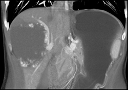 Giant Hemangioma - CTisus CT Scan