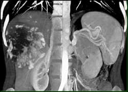 Giant Hemangioma - CTisus CT Scan