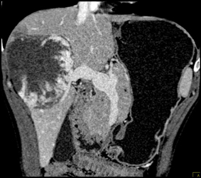 Giant Hemangioma - CTisus CT Scan