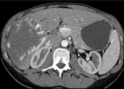 Giant Hemangioma - CTisus CT Scan