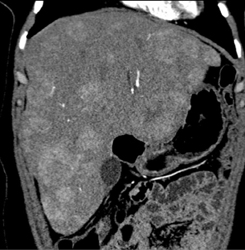 Metastatic Carcinoid Tumor - CTisus CT Scan